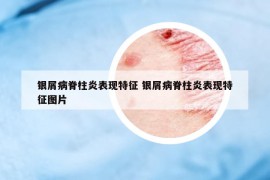 銀屑病脊柱炎表現(xiàn)特征 銀屑病脊柱炎表現(xiàn)特征圖片