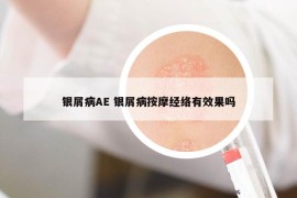 銀屑病AE 銀屑病按摩經(jīng)絡(luò)有效果嗎