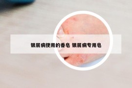 銀屑病使用的香皂 銀屑病專用皂