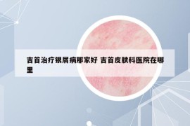 吉首治療銀屑病那家好 吉首皮膚科醫(yī)院在哪里