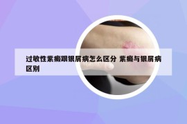 過敏性紫癜跟銀屑病怎么區(qū)分 紫癜與銀屑病區(qū)別
