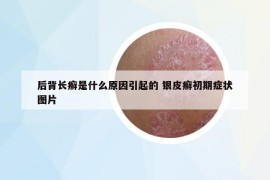 后背長癬是什么原因引起的 銀皮癬初期癥狀圖片