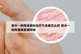 鄭大一附院皮膚科治療牛皮癬怎么樣 鄭大一附院看銀屑病咋樣
