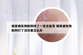 銀屑病生物制劑停了一定會(huì)復(fù)發(fā) 銀屑病生物制劑打了沒效果怎么辦