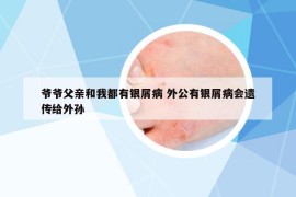 爺爺父親和我都有銀屑病 外公有銀屑病會(huì)遺傳給外孫