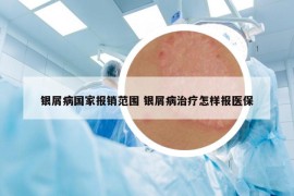 銀屑病國(guó)家報(bào)銷范圍 銀屑病治療怎樣報(bào)醫(yī)保