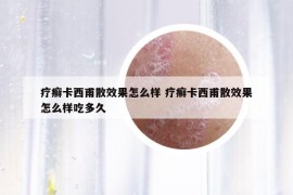 療癬卡西甫散效果怎么樣 療癬卡西甫散效果怎么樣吃多久