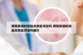 跟銀屑病的接觸皮膚能傳染嗎 跟銀屑病的接觸皮膚能傳染嗎圖片