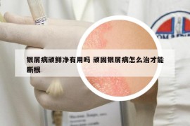 銀屑病頑鮮凈有用嗎 頑固銀屑病怎么治才能斷根