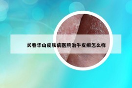 長春華山皮膚病醫(yī)院治牛皮癬怎么樣