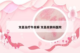 文昌治療牛皮癬 文昌皮膚科醫(yī)院