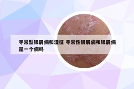 尋常型銀屑病和濕征 尋常性銀屑病和銀屑病是一個(gè)病嗎