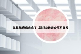 掌跎膿皰病自愈了 掌跎膿皰病如何不復發(fā)