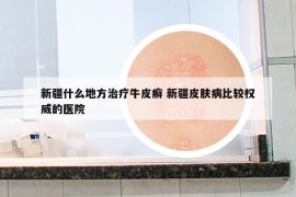 新疆什么地方治療牛皮癬 新疆皮膚病比較權(quán)威的醫(yī)院