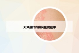 天津最好白癜風(fēng)醫(yī)院在哪