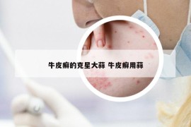 牛皮癬的克星大蒜 牛皮癬用蒜