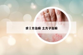 求傓方治癬 土方子治癬