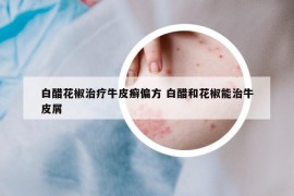 白醋花椒治療牛皮癬偏方 白醋和花椒能治牛皮屑