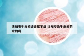 沈陽看牛皮癬請青菜不虛 沈陽專治牛皮癬藥水的嗎