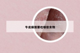 牛皮癬需要吃哪些食物
