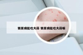 銀屑病能吃大蒜 銀屑病能吃大蒜嘛