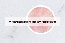 蘭州看銀屑病的醫(yī)院 銀屑病蘭州哪家醫(yī)院好