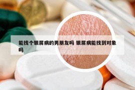 能找個(gè)銀屑病的男朋友嗎 銀屑病能找到對象嗎