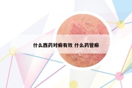 什么西藥對癬有效 什么藥管癬