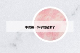 牛皮癬一懷孕就起來了
