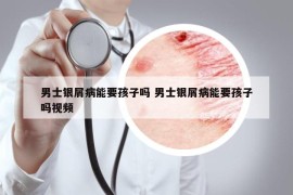 男士銀屑病能要孩子嗎 男士銀屑病能要孩子嗎視頻