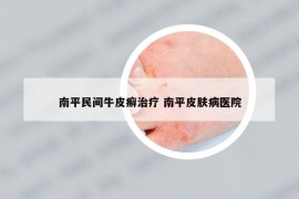 南平民間牛皮癬治療 南平皮膚病醫(yī)院