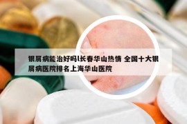 銀屑病能治好嗎l長春華山熱情 全國十大銀屑病醫(yī)院排名上海華山醫(yī)院