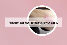 治療癬的最佳方法 治療癬的最佳方法是什么