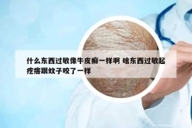 什么東西過敏像牛皮癬一樣啊 啥東西過敏起疙瘩跟蚊子咬了一樣