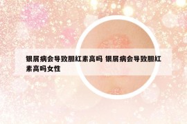 銀屑病會(huì)導(dǎo)致膽紅素高嗎 銀屑病會(huì)導(dǎo)致膽紅素高嗎女性