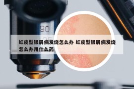 紅皮型銀屑病發(fā)燒怎么辦 紅皮型銀屑病發(fā)燒怎么辦用什么藥
