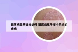 銀屑病是基礎(chǔ)疾病嗎 銀屑病屬于哪個(gè)系統(tǒng)的疾病