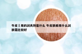 牛皮癬用的潤夫劑是什么 牛皮膚癬用什么潤膚霜比較好