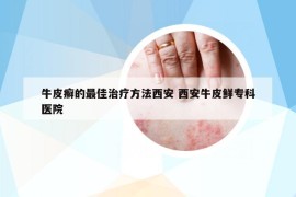 牛皮癬的最佳治療方法西安 西安牛皮鮮?？漆t(yī)院