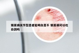 銀屑病關(guān)節(jié)型患者能喝白蒿不 銀屑病可以吃白鴿嗎