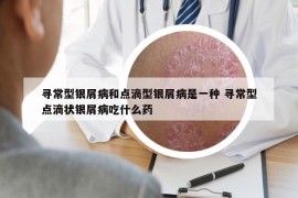 尋常型銀屑病和點(diǎn)滴型銀屑病是一種 尋常型點(diǎn)滴狀銀屑病吃什么藥