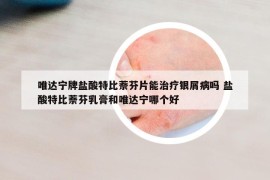 唯達(dá)寧牌鹽酸特比萘芬片能治療銀屑病嗎 鹽酸特比萘芬乳膏和唯達(dá)寧哪個好