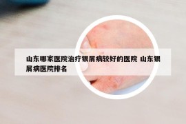 山東哪家醫(yī)院治療銀屑病較好的醫(yī)院 山東銀屑病醫(yī)院排名