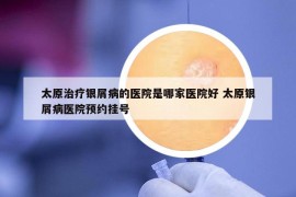 太原治療銀屑病的醫(yī)院是哪家醫(yī)院好 太原銀屑病醫(yī)院預(yù)約掛號