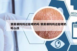 銀屑病媽媽還能喂奶嗎 銀屑病媽媽還能喂奶嗎小孩