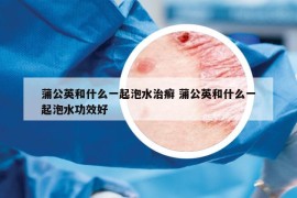 蒲公英和什么一起泡水治癬 蒲公英和什么一起泡水功效好