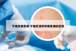 干燥性銀屑病 干燥性濕疹和銀屑病的區(qū)別