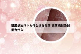 銀屑病治療中為什么還在發(fā)展 銀屑病越治越重為什么