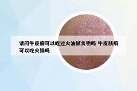請問牛皮癬可以吃過火油膩食物嗎 牛皮膚癬可以吃火鍋嗎