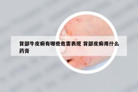 背部牛皮癬有哪些危害表現(xiàn) 背部皮癬用什么藥膏